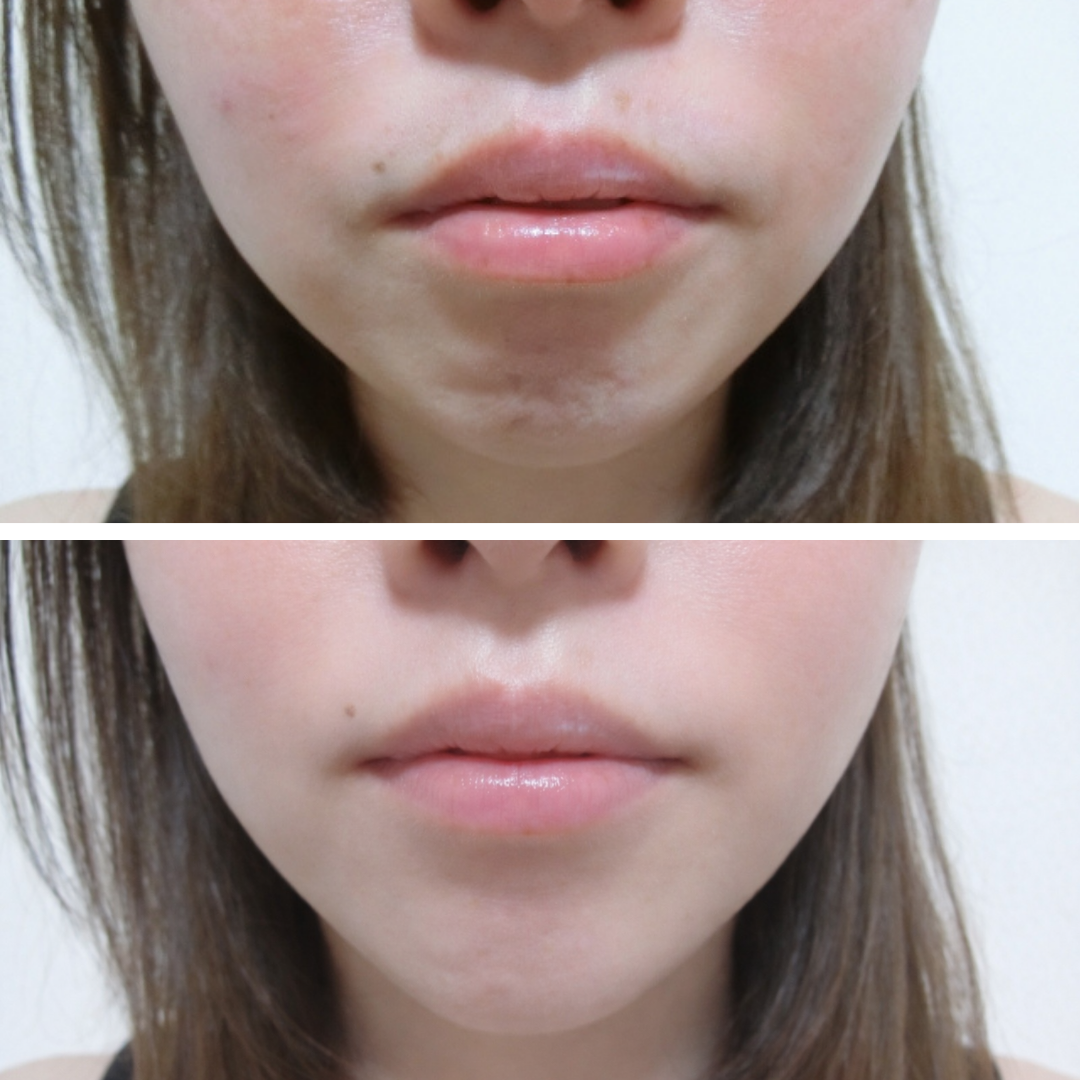 光フェイシャル