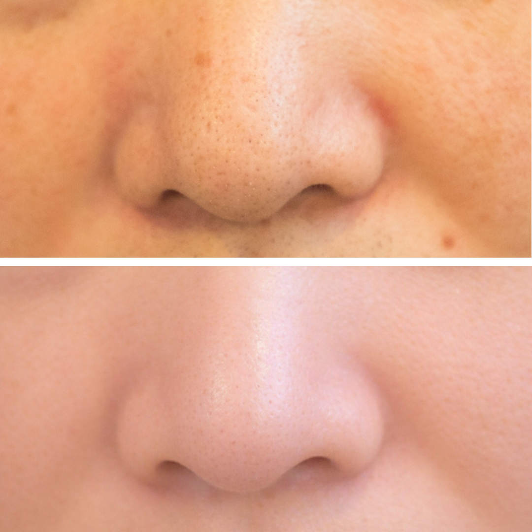 光フェイシャル