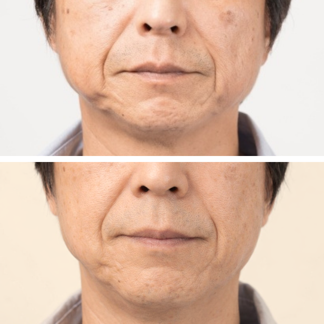 光フェイシャル